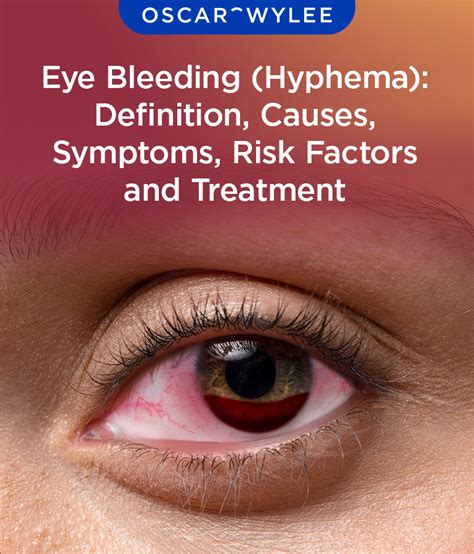 blood leaking from eye|Subconjunctival Hemorrhage: Symptoms, Causes